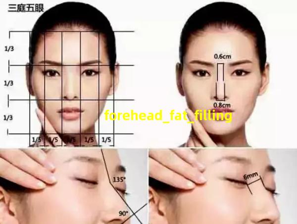 forehead_fat_filling